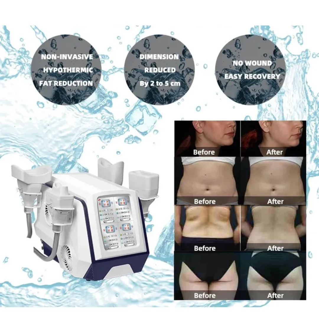 Surround-Freeze Cryo Machine Portable with 6 Medical Grade Applicators